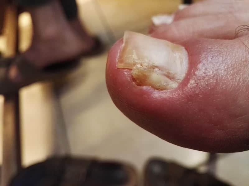 טיפול בציפורן חודרנית