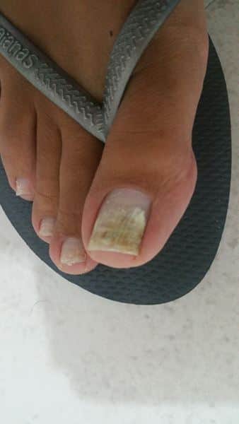 קנדידה ופטרת ציפורניים