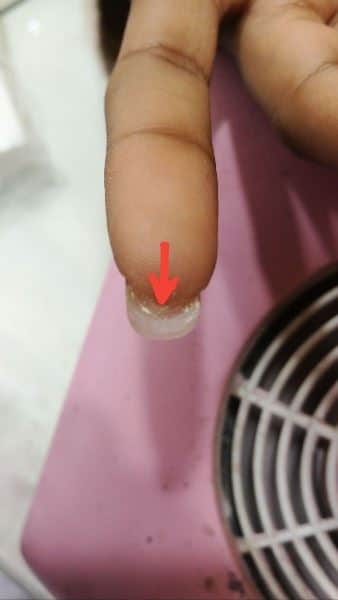 Pterygium - אנומליות בעור