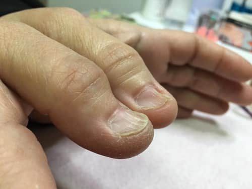 תופעות ציפורניים למתקדמות