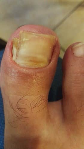 ציפורן חודרנית